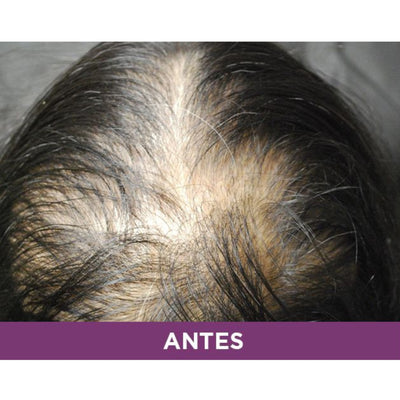 AMPOLLETAS PHYTO ANTICAIDA PROGRESIVA 12X5ML 91146